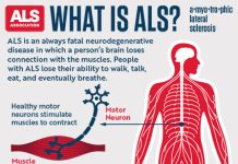 ALS Disease